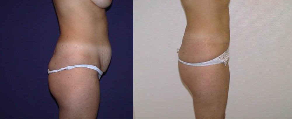 Avant / après · Plastie abdominale