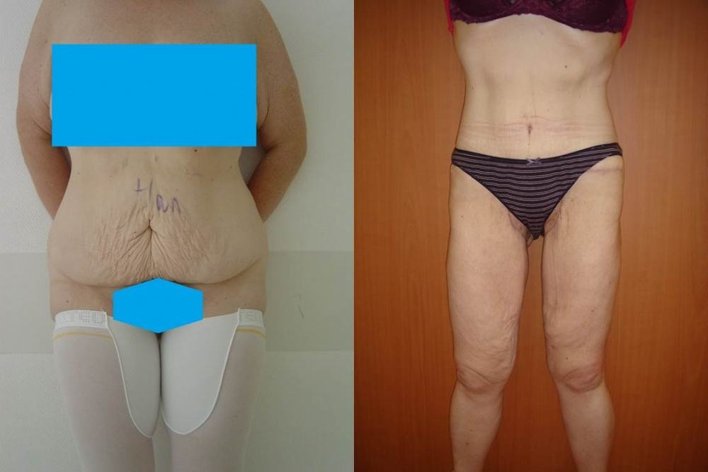Avant / après · Plastie abdominale