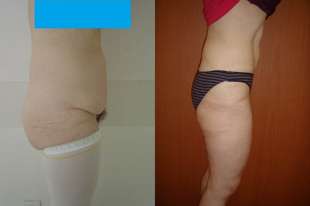 Avant / après · Plastie abdominale