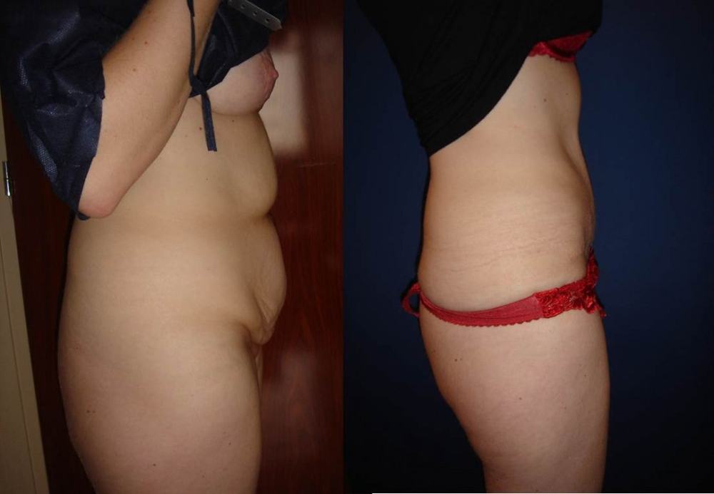 Avant / après · Plastie abdominale