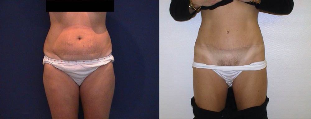 Avant / après · Plastie abdominale