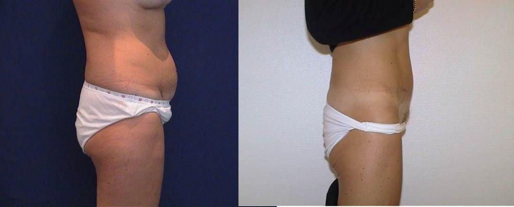 Avant / après · Plastie abdominale