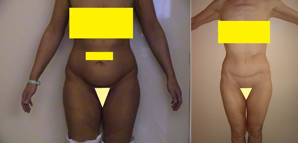 Avant / après · Plastie abdominale