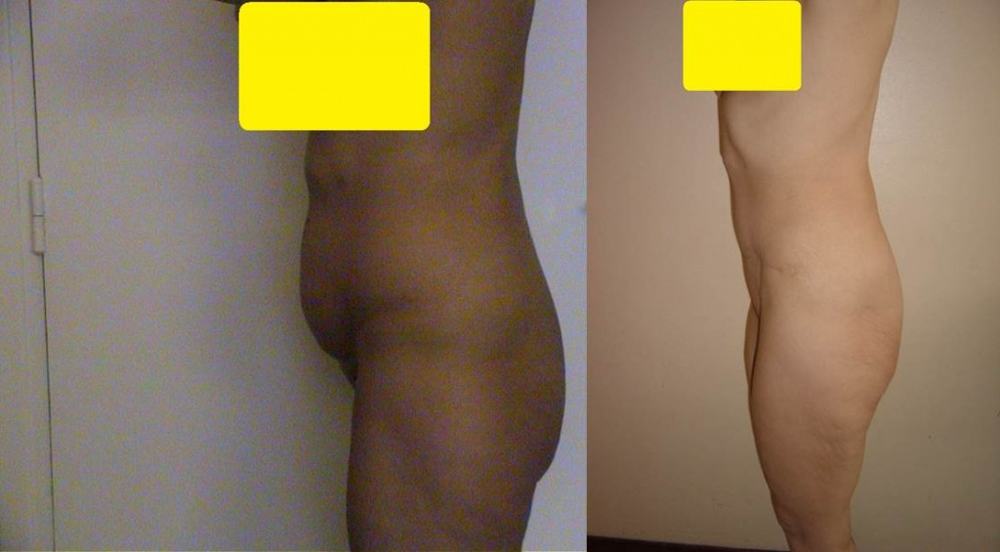 Avant / après · Plastie abdominale