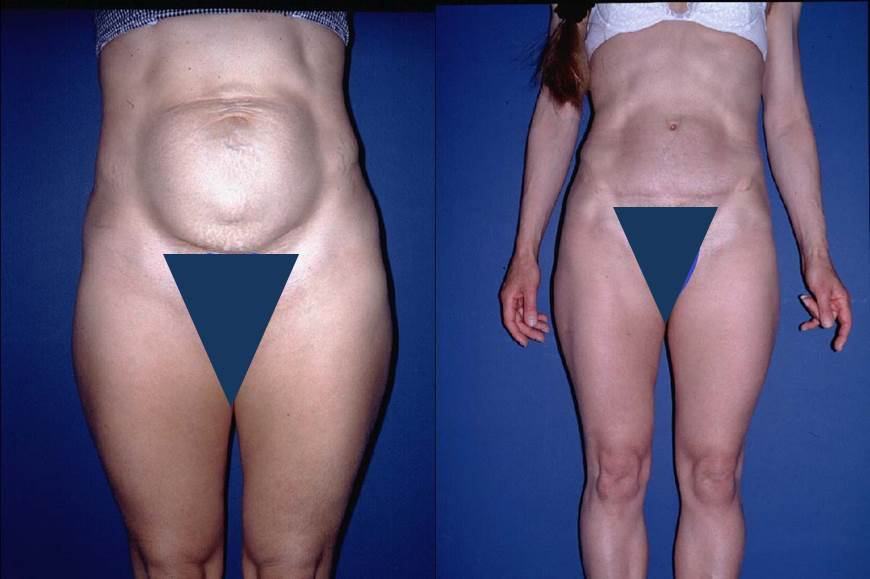 Avant / après · Plastie abdominale