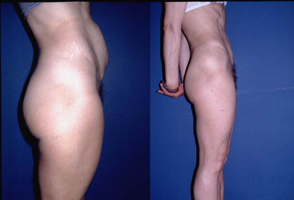 Avant / après · Plastie abdominale