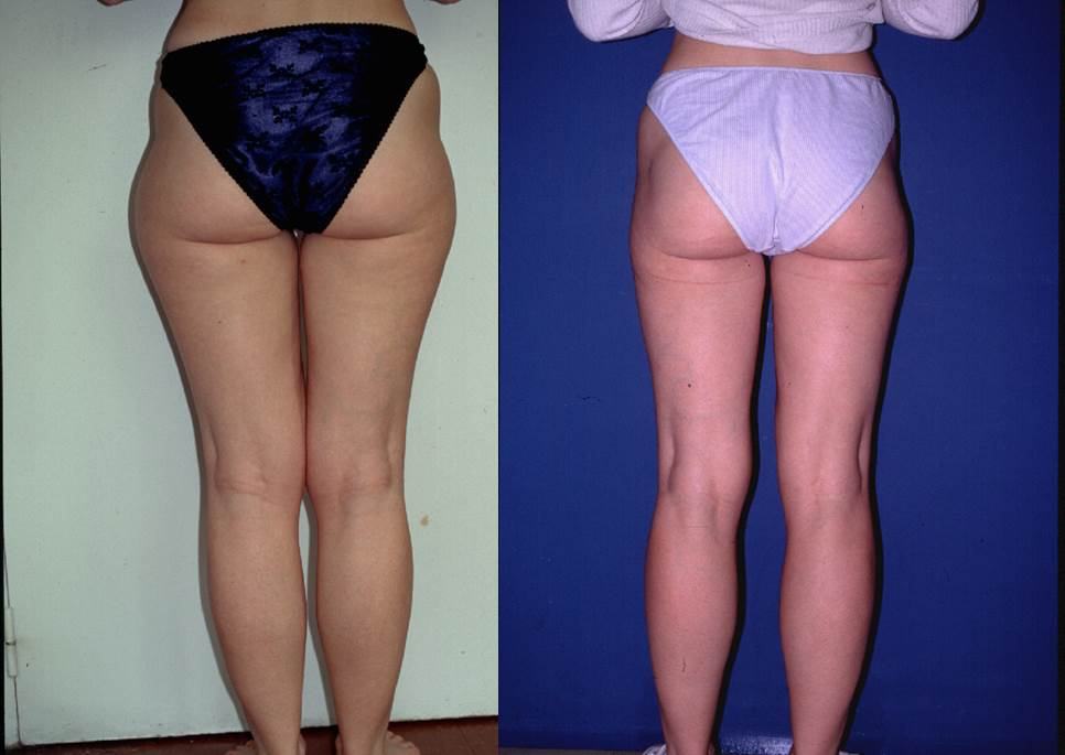 Avant / après · Lipoaspiration