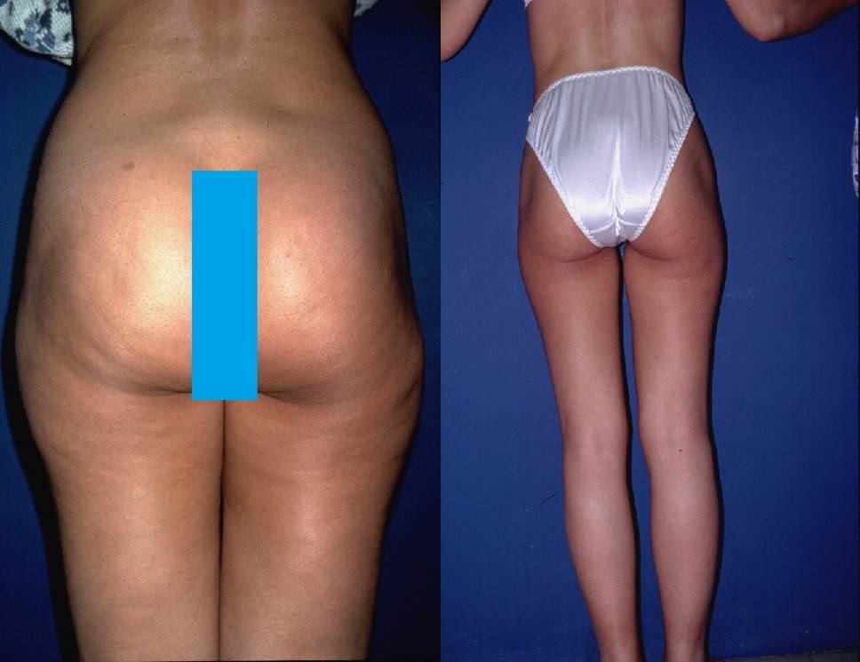 Avant / après · Lipoaspiration