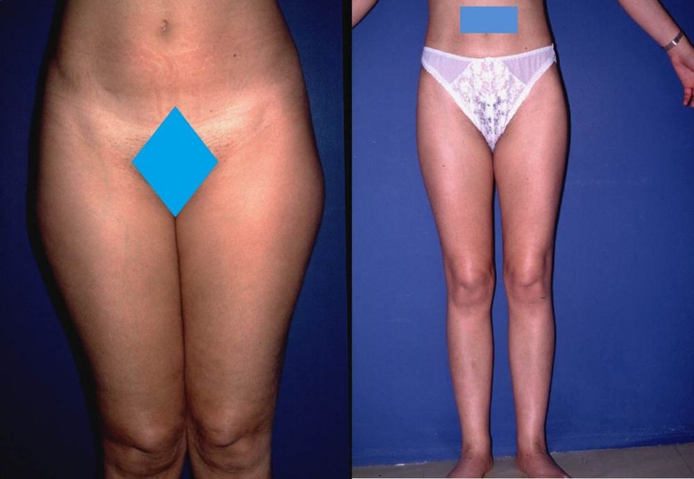 Avant / après · Lipoaspiration