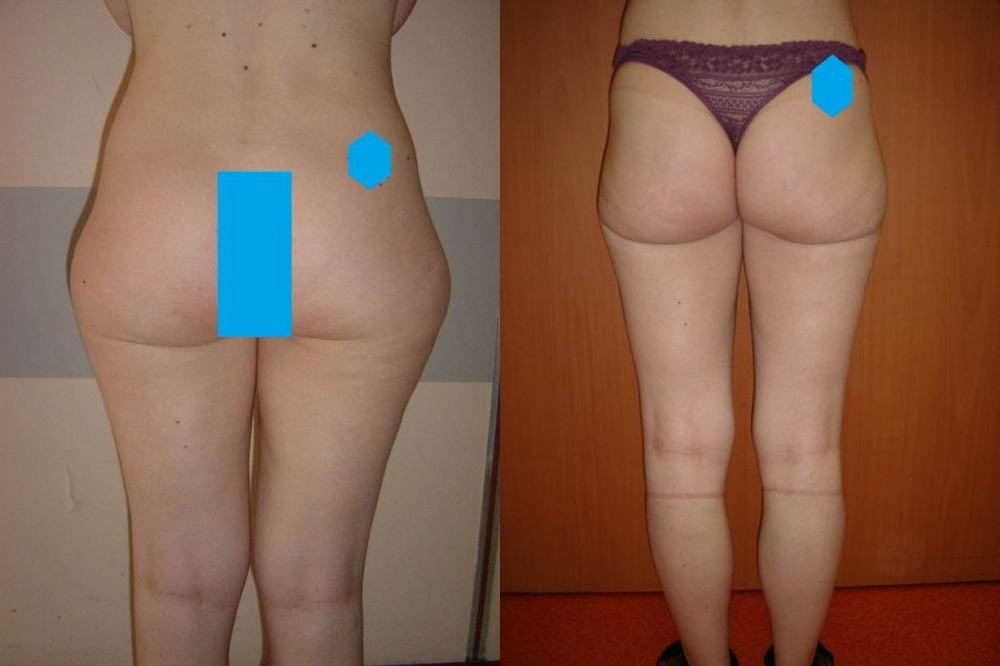 Avant / après · Lipoaspiration
