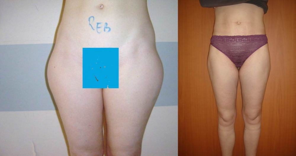 Avant / après · Lipoaspiration