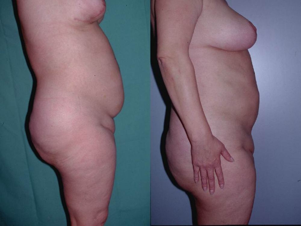 Avant / après · Lipoaspiration