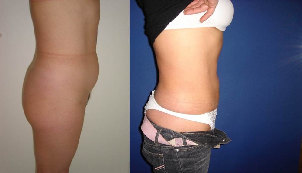 Avant / après · Lipoaspiration