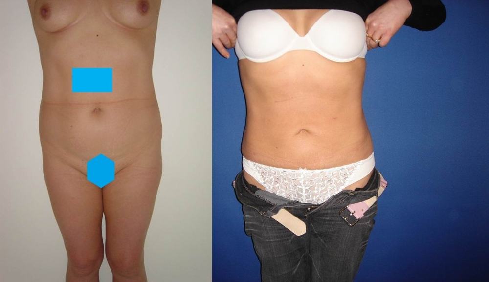 Avant / après · Lipoaspiration