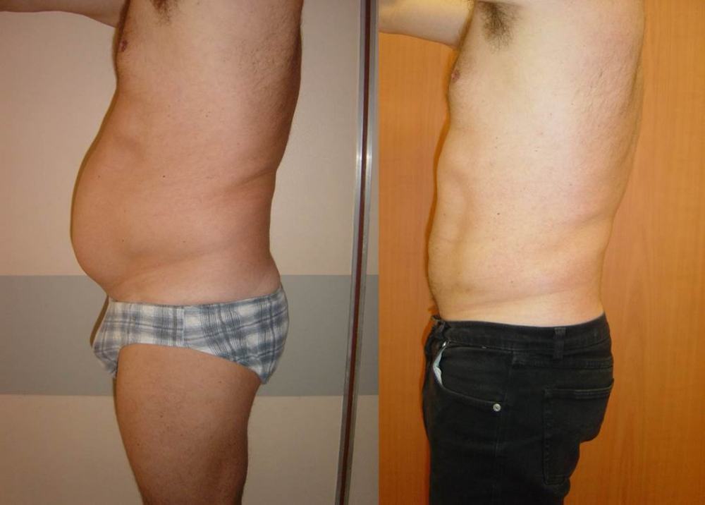 Avant / après · Lipoaspiration