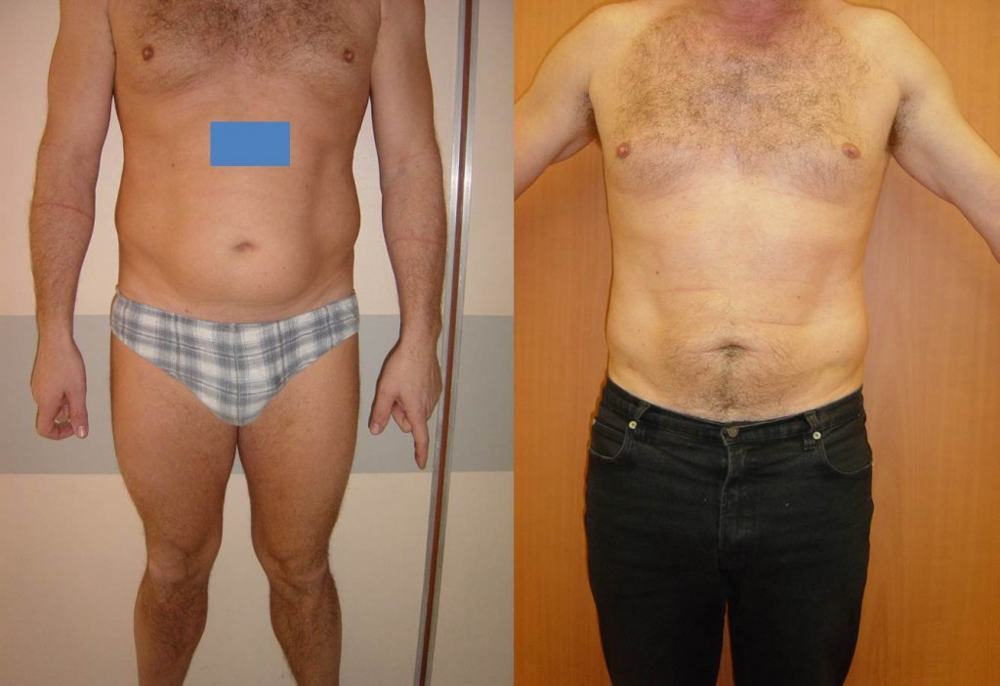 Avant / après · Lipoaspiration