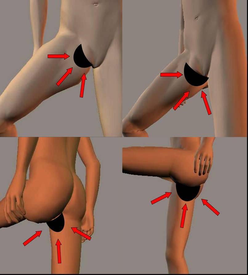 Avant / après · Plastie des cuisses