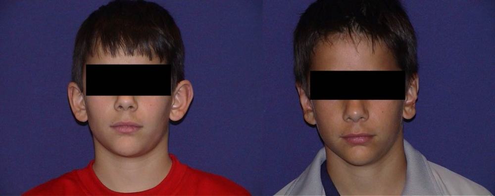 Avant / après · Oreilles décollées
