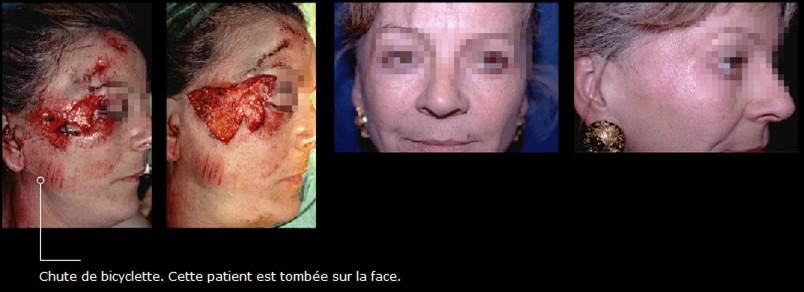 Avant / après · Reconstruction du visage