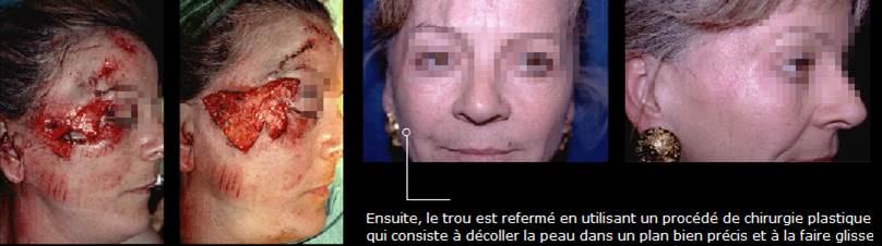 Avant / après · Reconstruction du visage