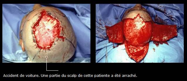 Avant / après · Reconstruction du visage