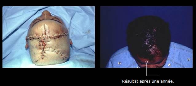 Avant / après · Reconstruction du visage