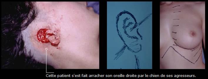 Avant / après · Reconstruction du visage