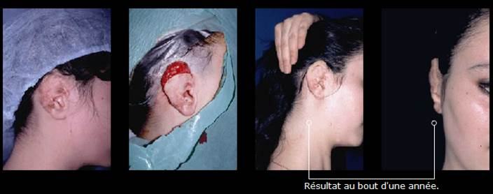 Avant / après · Reconstruction du visage