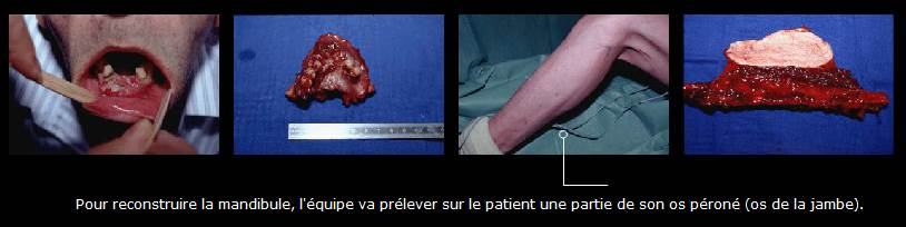 Avant / après · Reconstruction du visage