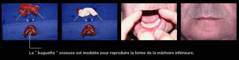 Avant / après · Reconstruction du visage