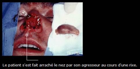 Avant / après · Reconstruction du visage