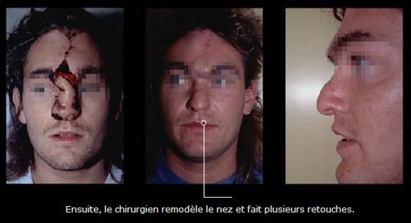 Avant / après · Reconstruction du visage