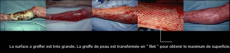 Avant / après · Reconstruction du membre inférieur