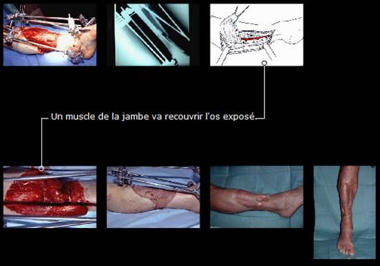 Avant / après · Reconstruction du membre inférieur
