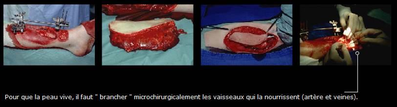 Avant / après · Reconstruction du membre inférieur
