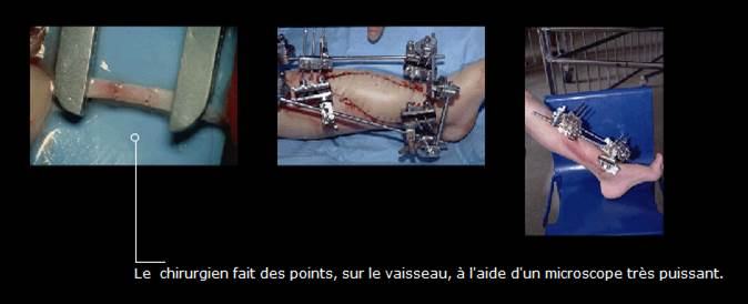 Avant / après · Reconstruction du membre inférieur