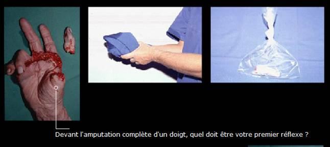 Avant / après · Reconstruction du membre supérieur & de la main