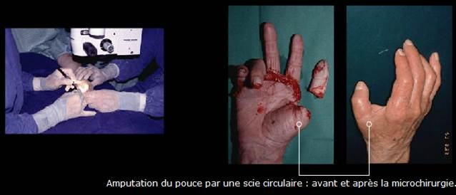 Avant / après · Reconstruction du membre supérieur & de la main