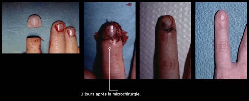 Avant / après · Reconstruction du membre supérieur & de la main